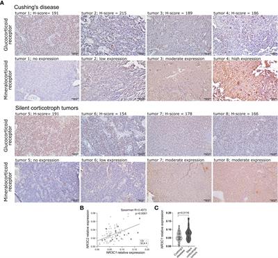 The expression of glucocorticoid and mineralocorticoid receptors in pituitary tumors causing Cushing’s disease and silent corticotroph tumors